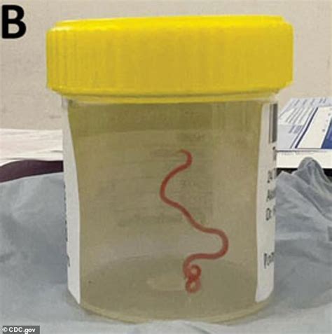 Shocked Medics Find Cm Parasitic Worm Normally Seen In Pythons