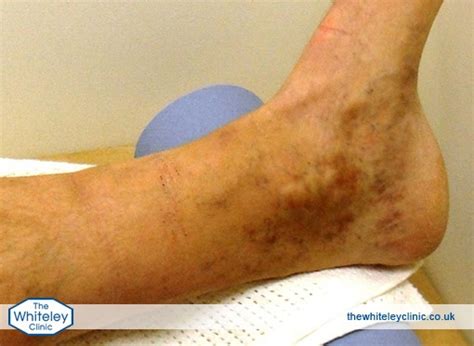 Tests For Phlebitis The Whiteley Clinic