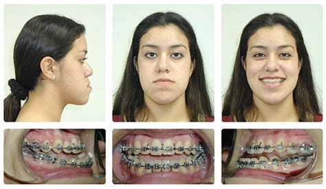 Underbite Before And After Braces