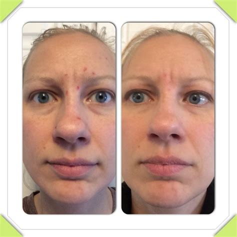 Before And After Photos Of Just 2 Weeks Using Nerium Anti Aging Skin