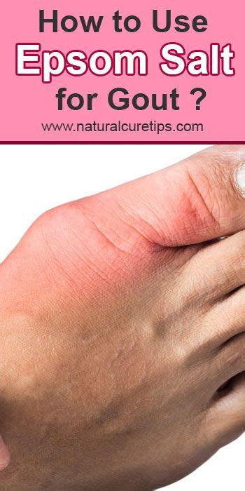 How To Use Epsom Salt For Gout Gout Treatment Natural Remedies For