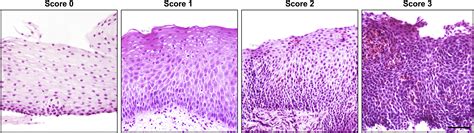 Persistent Basal Cell Hyperplasia Is Associated With Clinical And