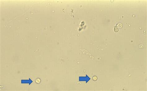 Microscopic Urinalysis Images Set Flashcards Quizlet