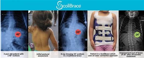 Will Scoliosis Go Away On Its Own Scoliosis Clinic Uk Treating