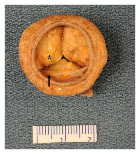 Carpentier Edwards Pericardial Valve Stent Covered With Ptfe Fabric