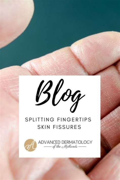 Fingertips Splitting Severe Dry Skin Dermatology Skin