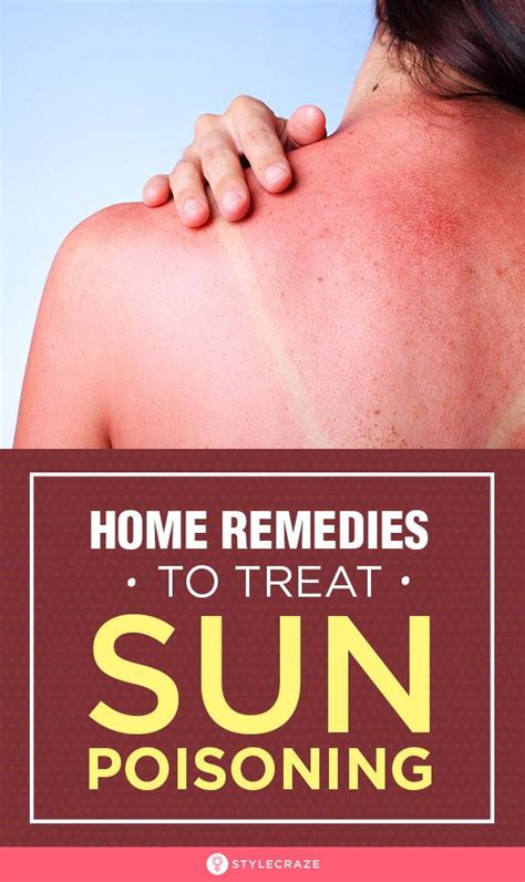 10 Natural Remedies To Treat Sun Poisoning At Home Sunburn Treatment
