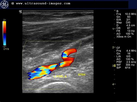 Cochinblogs Doppler Study Severe Stenosis Of The Lower Limb Arteries