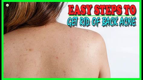 8 Effective And Easy Steps To Get Rid Of Back Acne Naturally Best