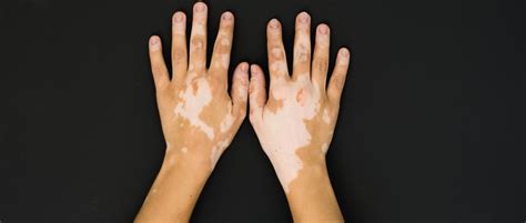How To Stop Vitiligoleucoderma Safed Daag From Spreading