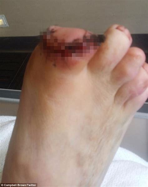 Gold Coast Man Has Toes Chewed Off By His Pet Chihuahua