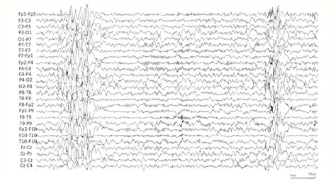 Eeg Showing Generalized Epileptiform Discharges On A Slow Background