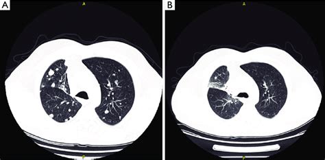 Radiographic Changes In Chest Computed Tomography Scan From Case 4 A