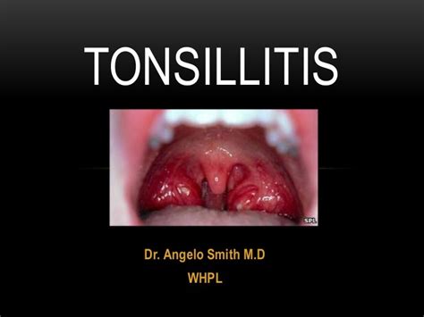 Tonsillitis