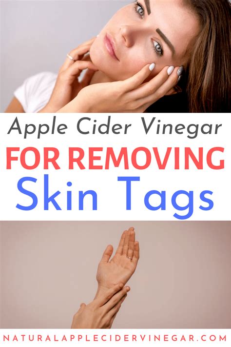 how to use apple cider vinegar to remove skin tags skin tag removal skin tag home remedies
