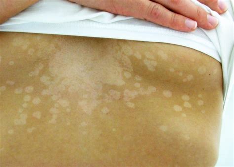 Home Remedies For White Patches And Skin Spots Tinea Versicolor