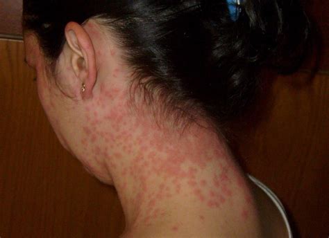 Do You Have Anxiety Rash Causes Effects And Treatments Betterhelp