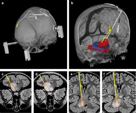 Treatment Of The Diffuse Intrinsic Pontine Glioma Using A Chronic Download Scientific Diagram