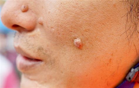 Cysts Lumps Bumps And Your Skin Vrogue Co