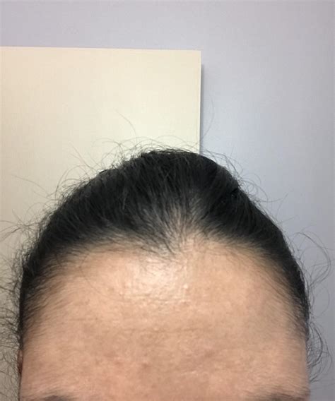 Skin Concerns How Do I Get Rid Of These Bumps On My Forehead R