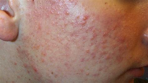 Pimples On Body And Face Skin Bump Underneath Transfagarasan Media