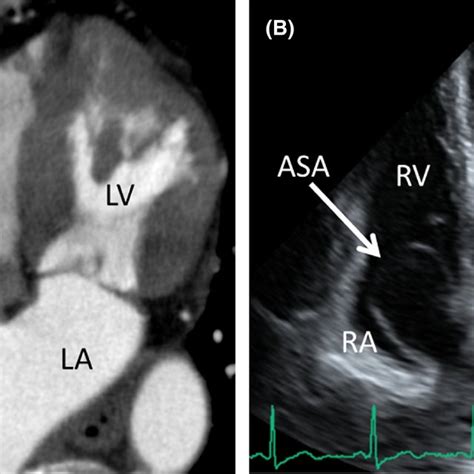 Pathological Findings Of An Atrial Septal Aneurysm Blood‐stained Gauze