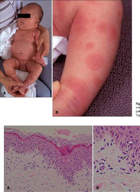 Figure 1 From Neonatal Erythema Multiforme A Case Report Semantic