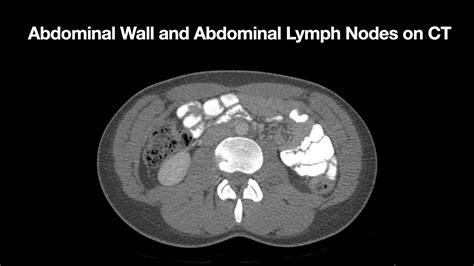 Anatomy Of The Abdominal Wall And Abdominal Lymph Node Stations Youtube