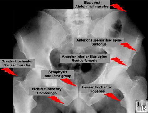 Asis) is a bony projection of the iliac bone and an important landmark of surface anatomy. anterior superior iliac spine - meddic