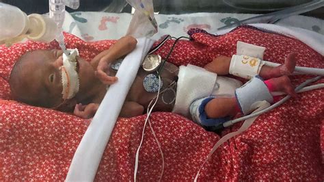 Premature Baby Born At Weeks Is One Of The Babeest Ever To Survive