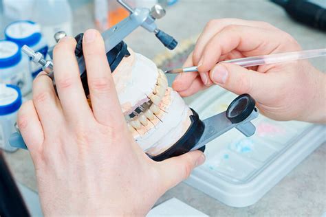 Tipos De Puentes Dentales Diferencias Y Beneficios Adeslas Dental Hot