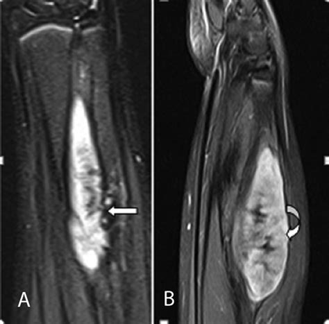 Mri Of Left Forearm In Coronal A And Sagittal B T2w Stir Shows