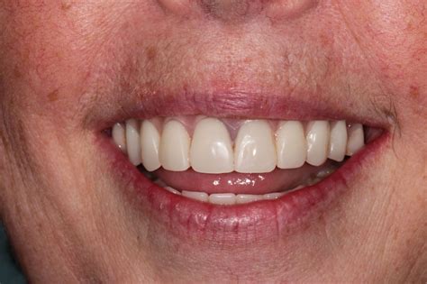 Dental Implants All Smiles Dental
