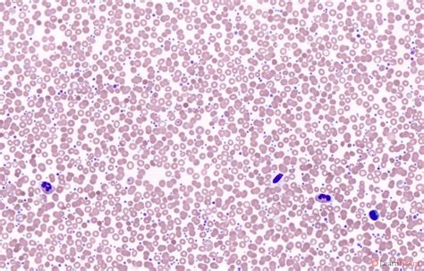 Polycythemia Vera Blood Smear