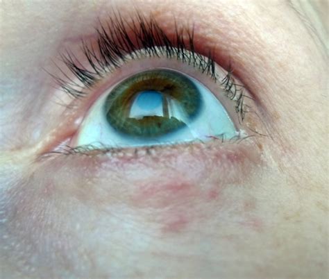 Small Red Pimples Below Lower Eyelid Thread Discussing Small Red