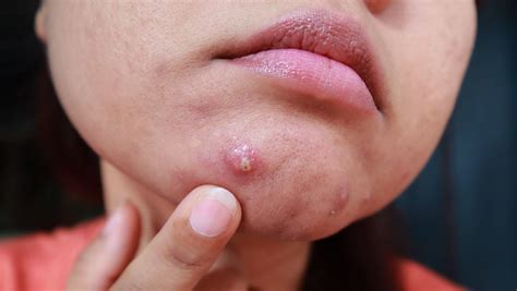 Pustules Everything You Need To Know About Pustules And How To Treat