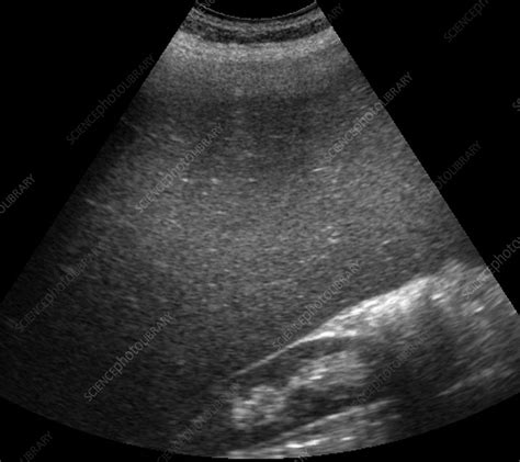 Enlarged Spleen Ultrasound Scan Stock Image C0035024 Science