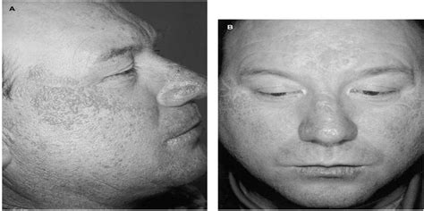 Adult Onset Facial Colloid Milium Successfully Treated With