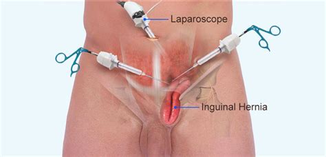 Laparoscopic Vs Open Hernia Repair Advantages Disadvantages