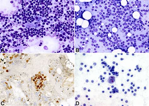 Lymph Node Cytopathology Essential Ancillary Studies As Applied To