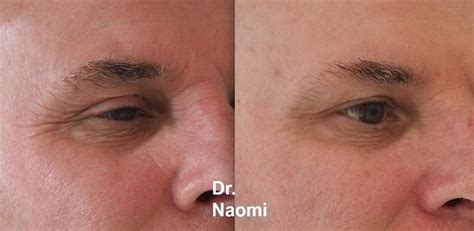 Male Cosmetic Treatments Best Clinic Sydney For Dermal Fillers