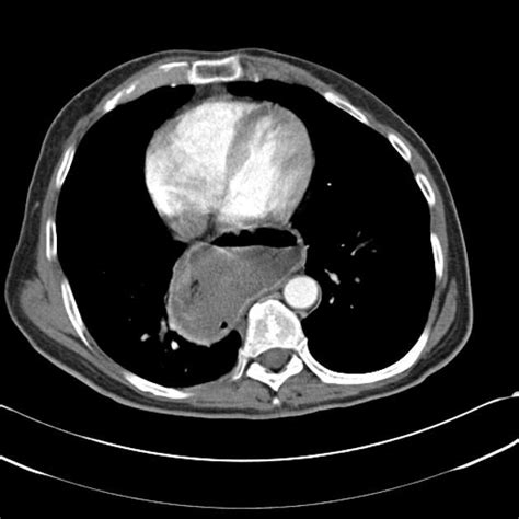 Hiatus Hernia Radiology Case Hiatus Hernia