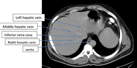 Radiological Anatomy Of The Liver Semantic Scholar