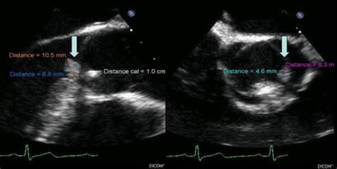 Cardiobacterium Hominis Endocarditis Presenting As Acute Embolic Stroke