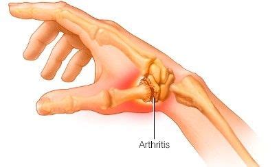 There are more than 100 different kinds of arthritis and related conditions. I Think I Have Thumb Arthritis - What Do I Do About It? in ...