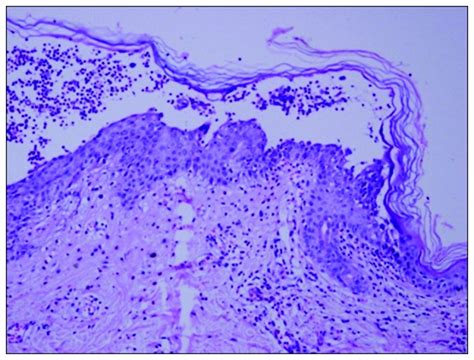 Histopathology Of The Skin Lesion Subcorneal Pustular Marginal