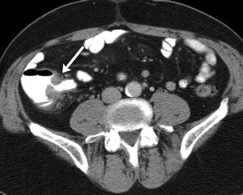 Primary Gastrointestinal Lymphoma Spectrum Of Imaging Findings With