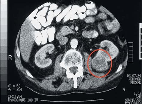 Stage 1 Ct Scan Kidney Cancer Kidausx