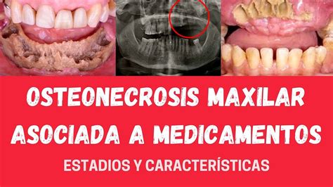 Osteonecrosis Maxilar Asociada A Medicamentos Estadios Y