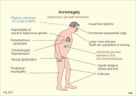 acromegaly nursing care plan and management rnpedia